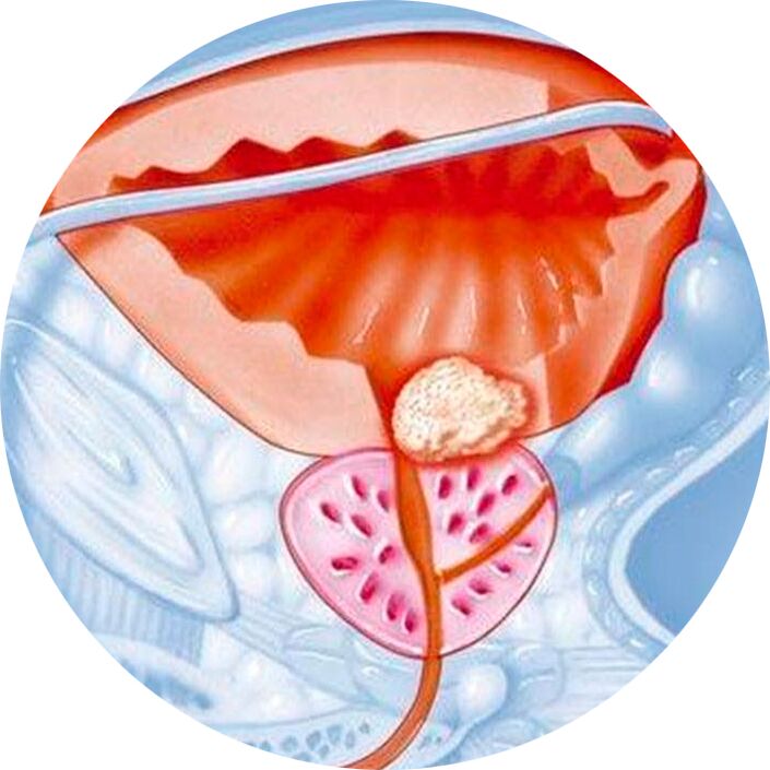 Adenoma of the prostate